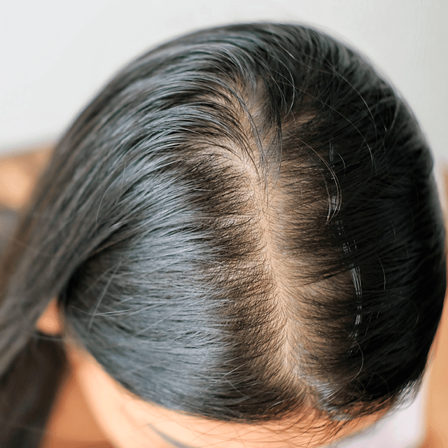 Female-hair-loss-is-treated-at-hair-neva-clinic-640-640px