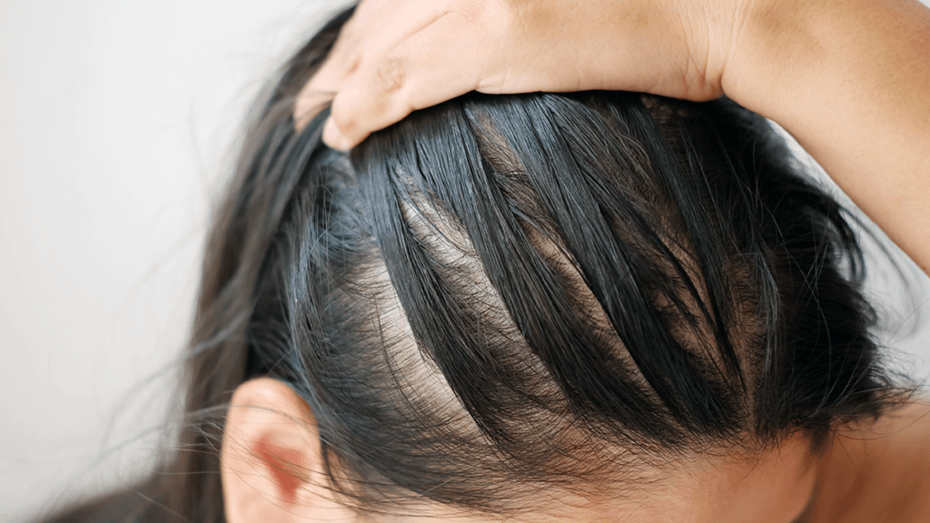 Female Pattern Baldness Causes Symptoms And Treatment