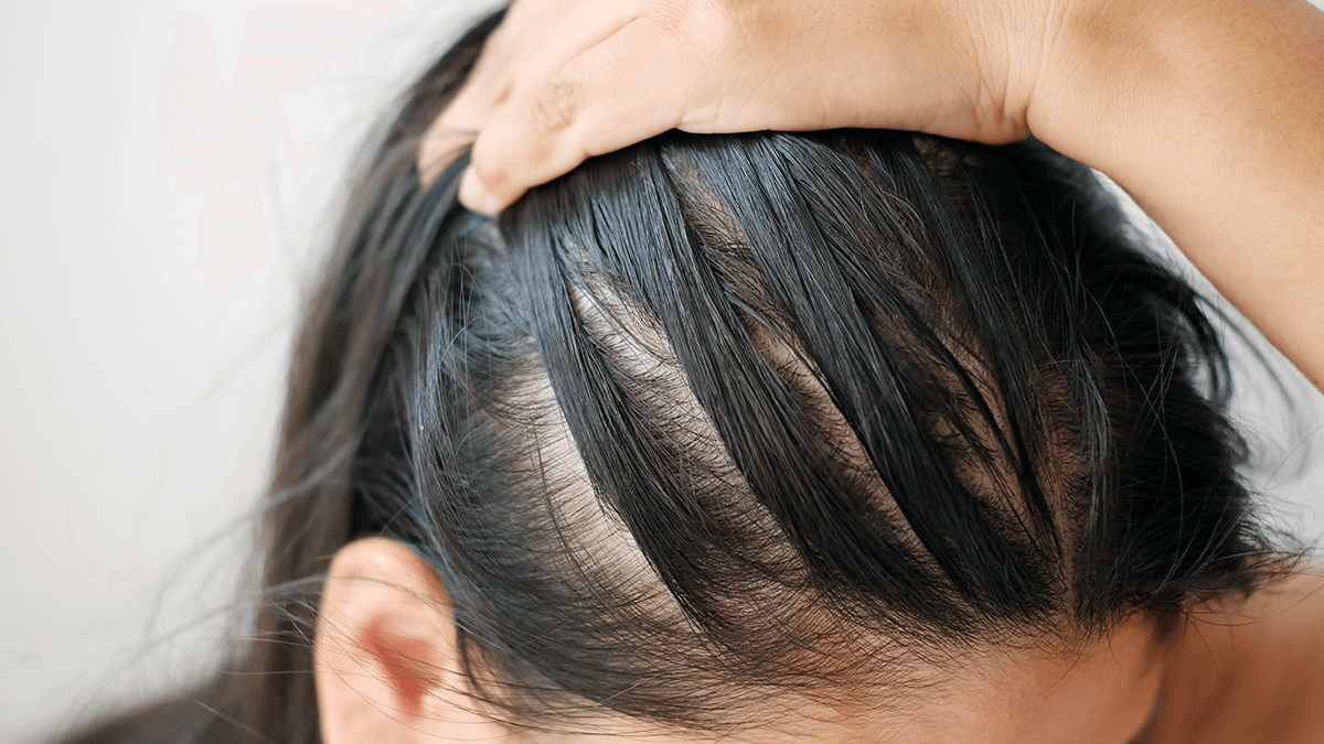 Female Pattern Baldness Causes Symptoms And Treatment