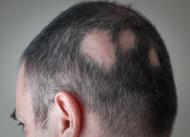 Male-pattern-baldness-is-treated-at-Dr-Tayfun-Oguzoglu-clinic