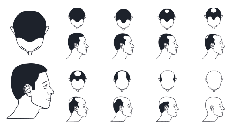 The Norwood Scale of hair loss - All you need to know in 2023