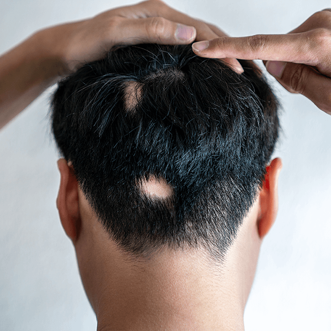 The-symptoms-of-losing-hair-675-675px