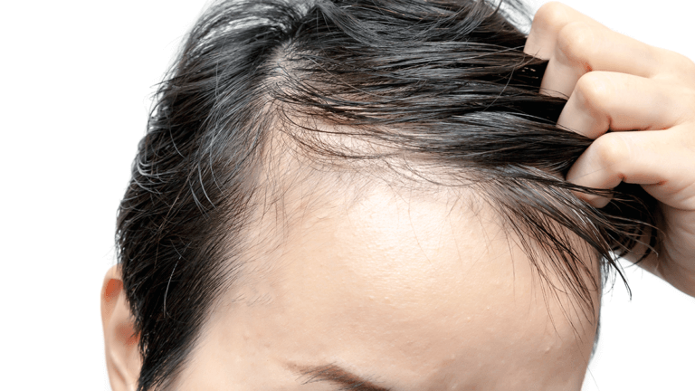 Receding Hairline - Causes, symptoms and treatments in 2024