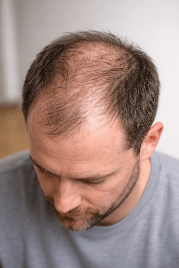 Crown Hair Transplants